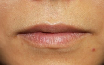 Lip Injection before 508928