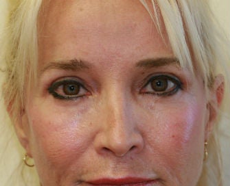 Eyelid rejuvenation after 378919