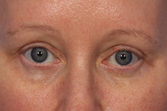Botox to Crows Feet and Between Eyes (Glabella) after 308334