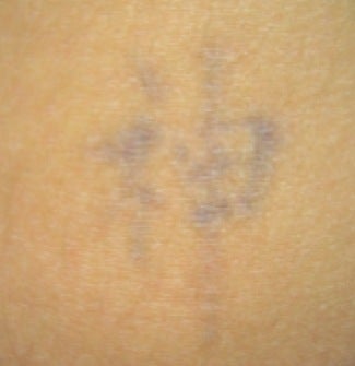 Laser tattoo removal after 374509