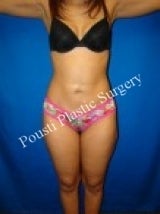 Liposuction after 633679