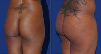 Brazilian Butt Lift after 494510