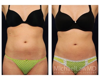 Liposuction before 495007
