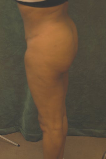Women's Buttocks Augmentation before 518126
