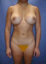 Liposculpture, Liposuction and Breast Augmentation after 151054