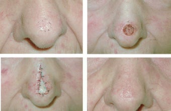 MOHS Skin Cancer Surgery before 369215