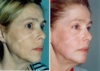 Non-Surgical Face Lift- Exoderm before 242985