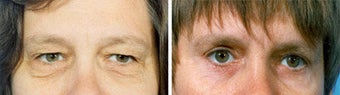 Blepharoplasty before 643235