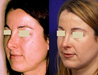Revision Rhinoplasty before 127037
