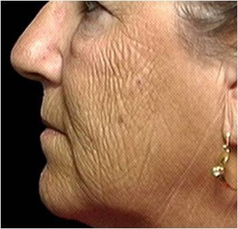 CO2 Laser Skin Resurfacing before 255555