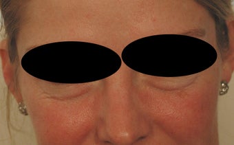Restylane for Eye Bags before 486784