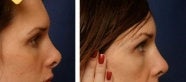 Rhinoplasty revision before 130780
