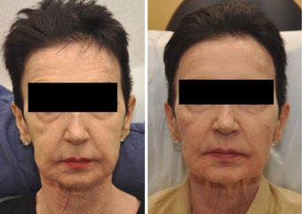 Cheek Augmentation before 216631
