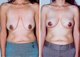 Mastopexy-Breast Lift before 243707