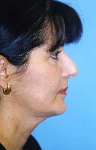 Chin Implant after 409957