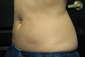 Zeltiq CoolSculpting after 504019