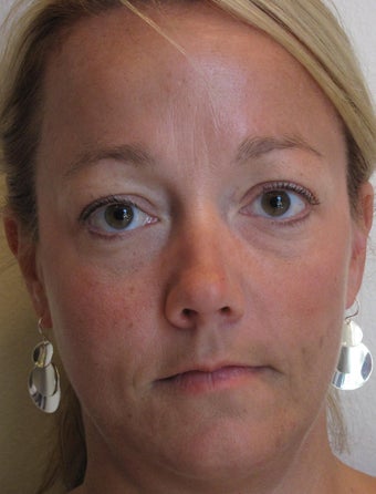 Dermal Filler after 601420
