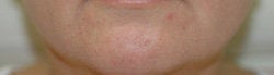 Restylane and Botox for mouth rejuvenation before 93349