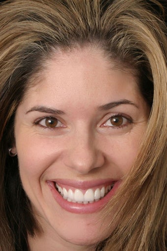 Eight porcelain veneers on upper teeth closing midline space. after 391877