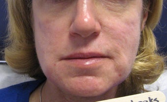 Radiesse Cheeks, below corners of mouth, marrionettes and jawline before 248381