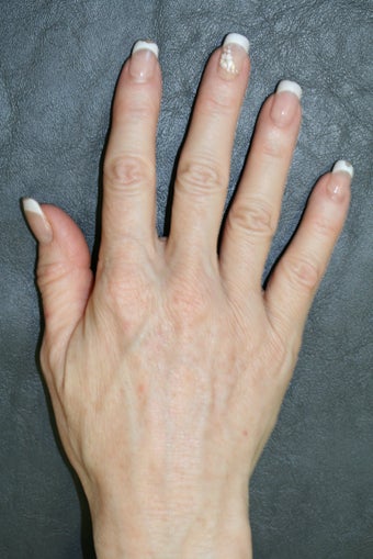 Radiesse treatment for hand rejuvenation after 165259