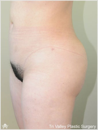 Brazilian Buttock Lift after 420872