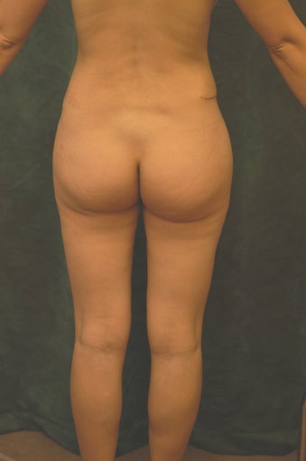 Women's Buttocks Augmentation 518135
