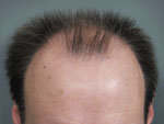 Hair Transplant before 426679