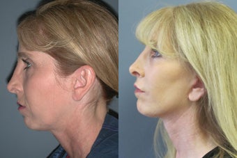 Lite Lift™ before 523696