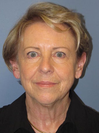 Neck Lift, Platysmaplasty before 634752