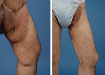 Thighplasty before 335981