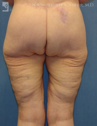 Backlift after 502540