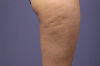 Cellulaze before 576598