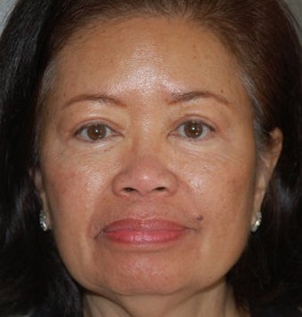 Upper Lid Blepharoplasty & NS Cheek Enhancement (Radiesse) after 104590