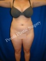 Liposuction before 632171