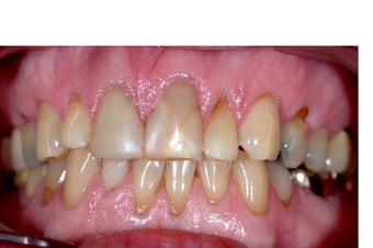 Full Mouth Reconstruction before 358133