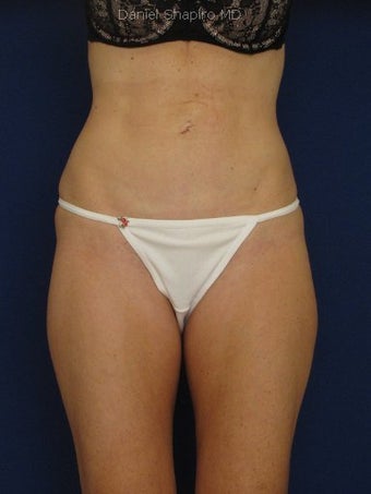 Tummy Tuck Revision with Vaser Liposuction of the abdomen before 422791