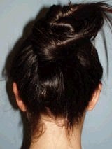 Ear Surgery (Otoplasty) 357652