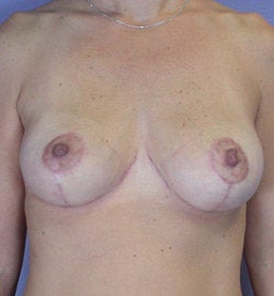 Breast Lift after 285359