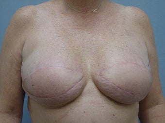 Breast Reconstruction after 98013