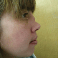 Revision Rhinoplasty 443001
