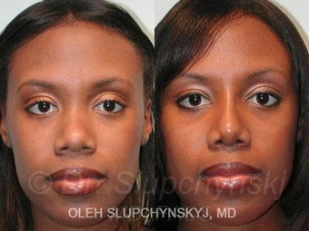 African American Rhinoplasty after 374015