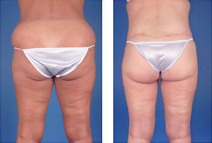 Central body lift with liposuction age 38 before 6816