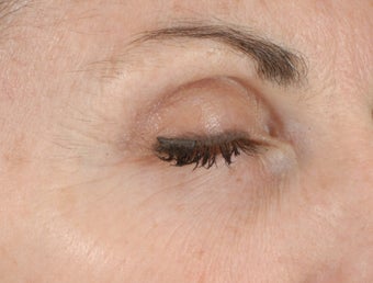 Ulthera Laser Skin Tightening after 346273