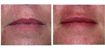 Lip rejuvenation before 60632