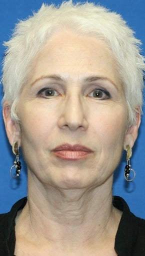 Short Incision face lift and neck lift before 223338