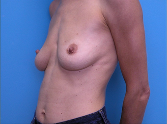 Breast Reconstruction before 310525