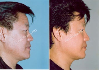 Non-Surgical Face Lift- Exoderm before 242990