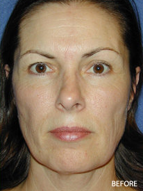 Cheek Impant Surgery before 328073