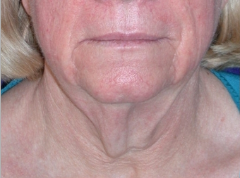Necklift before 208458